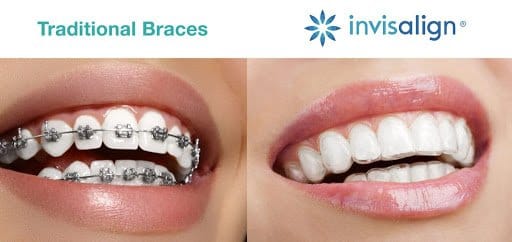 Traditional braces vs. Invisalign