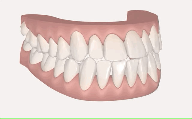 My Invisalign Treatment Animation