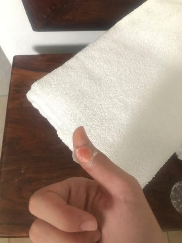 And then a stall door took a piece of my thumb.