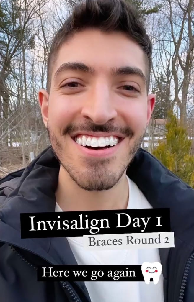 My Smile: Invisalign Day 1