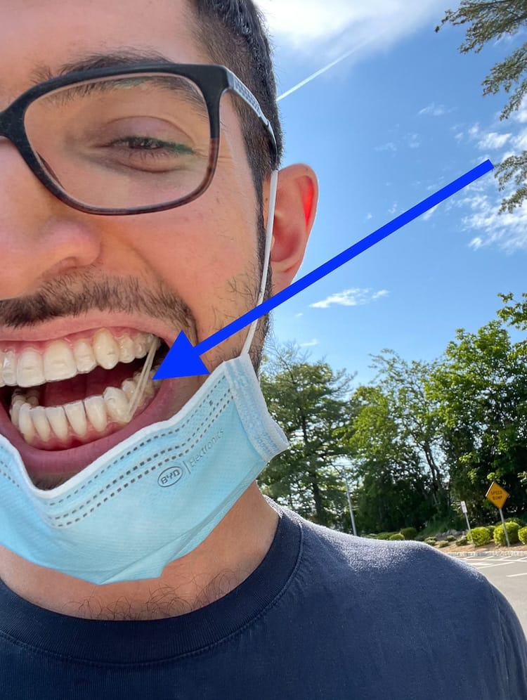 Invisalign can have rubber bands too