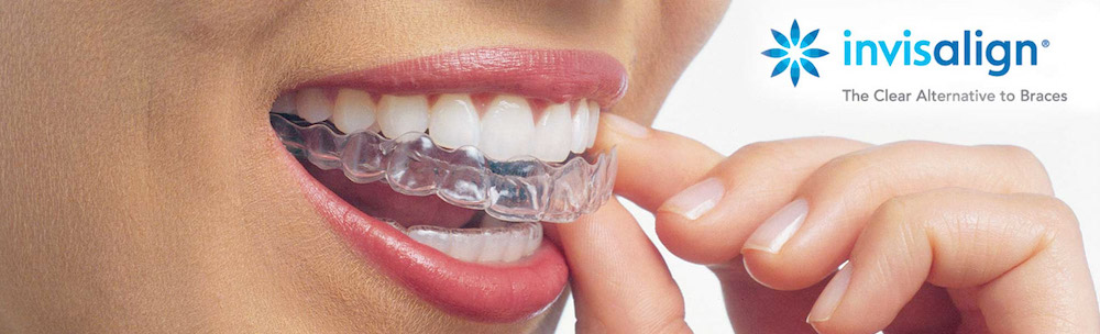 Invisalign aligners